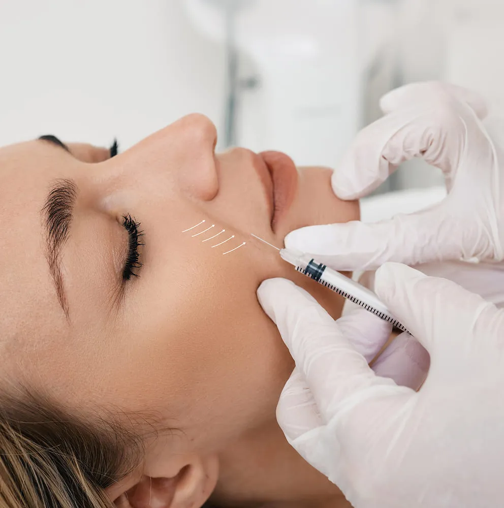 Nasolabial Folds & Marionette Lines