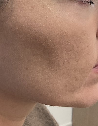 Acne — Chemical Peel - After