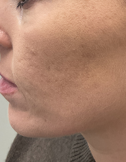 Acne — Laser Therapy - After