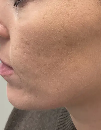 Acne Isotretinoin Result 1 - After