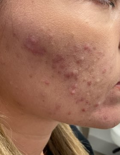 Acne — Chemical Peel - Before