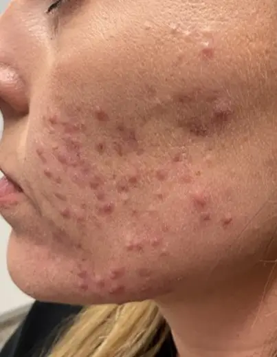 Acne Isotretinoin Result 1 - Before