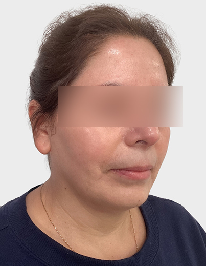 Rosacea — DermaV Laser - After