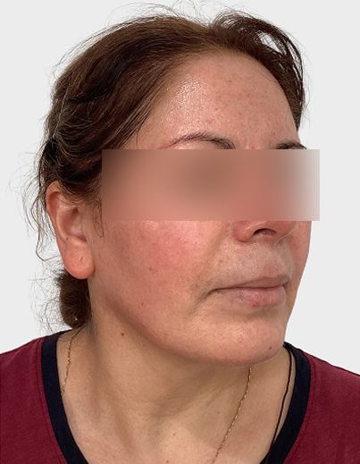 Rosacea — DermaV Laser - Before