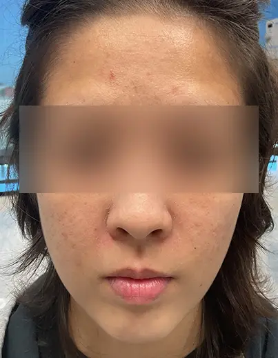 Acne — Prescription Topicals - After