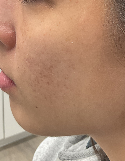Acne — Combination Care - After