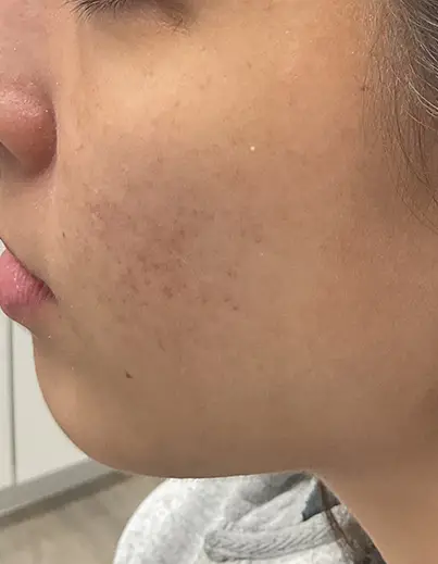 Acne — Combination Care - After