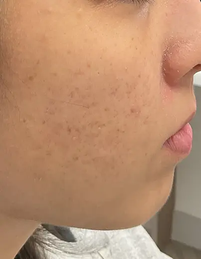 Acne — Post-Breakout Marks - After