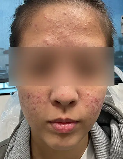 Acne — Prescription Topicals - Before