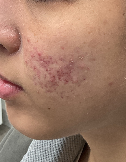 Acne — Combination Care - Before