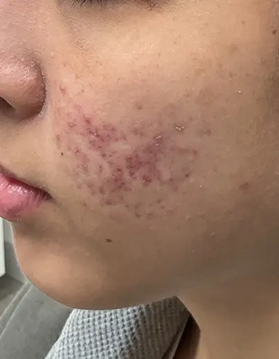 Acne — Combination Care - Before