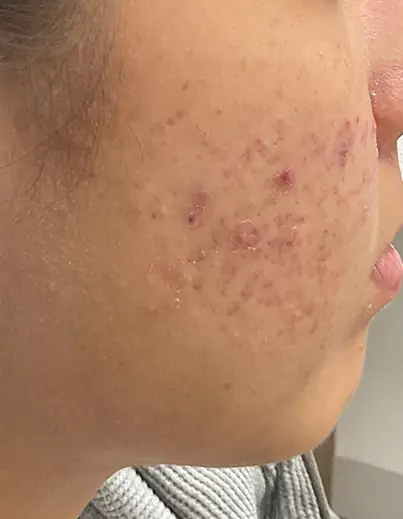 Acne — Post-Breakout Marks - Before