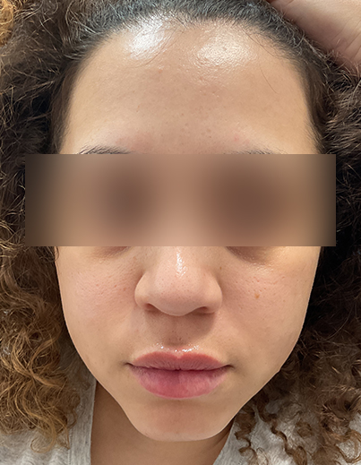 Acne — Cystic Acne Care - After