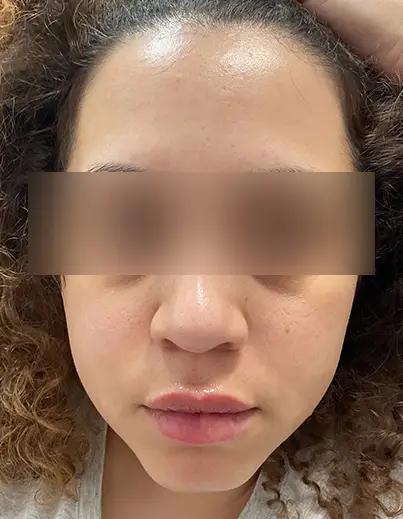 Acne Isotretinoin Result 2 - After