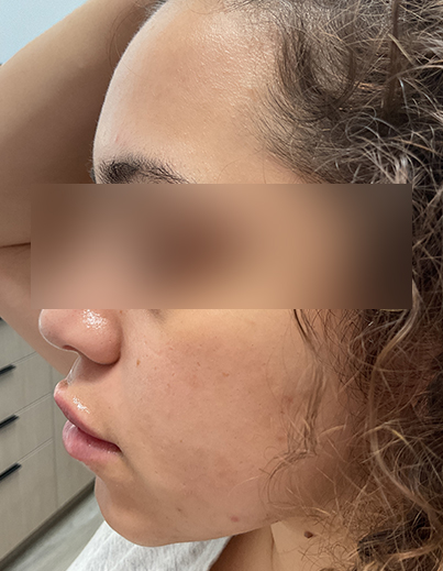 Acne — Extraction Treatment - After