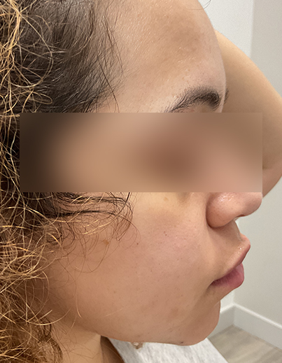 Acne — Hormonal Breakouts - After