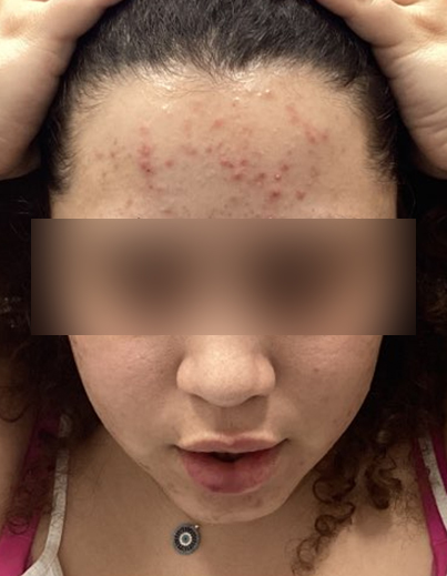 Acne — Cystic Acne Care - Before