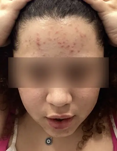 Acne Isotretinoin Result 2 - Before