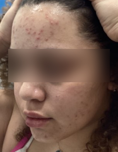 Acne — Extraction Treatment - Before