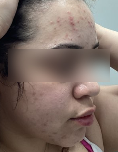 Acne — Hormonal Breakouts - Before
