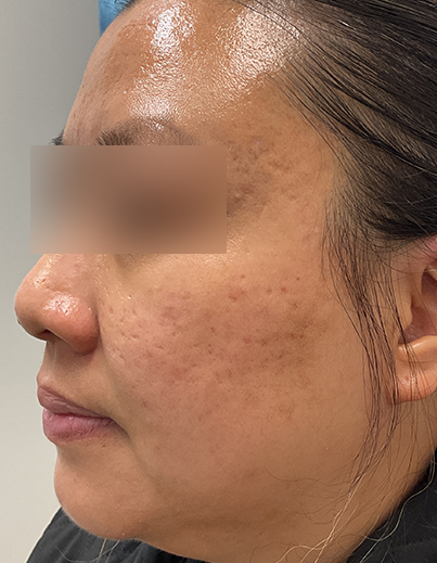 Acne — Salicylic Acid Peel - After
