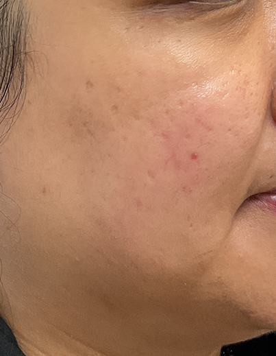 Acne — Inflammatory Breakouts - After
