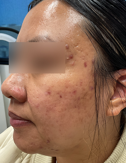 Acne — Salicylic Acid Peel - Before