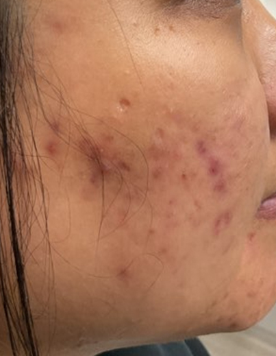 Acne — Inflammatory Breakouts - Before