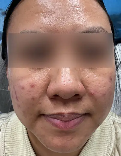 Acne Isotretinoin Result 3 - Before