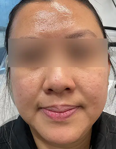 Acne Isotretinoin Result 3 - After