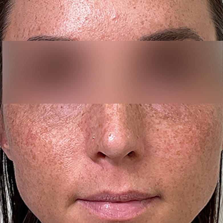 Sculptra — Midface Volume - After