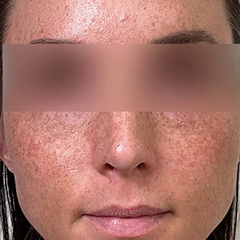 Sculptra — Midface Volume - After