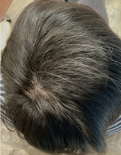 Alopecia Areata Treatment - After