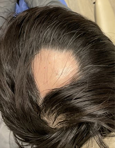 Alopecia Areata Treatment - Before