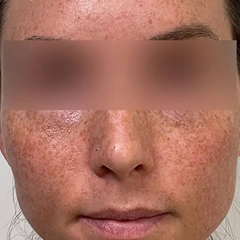Sculptra — Midface Volume - Before