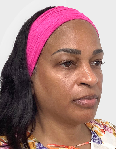 Cheek Temple Filler - After