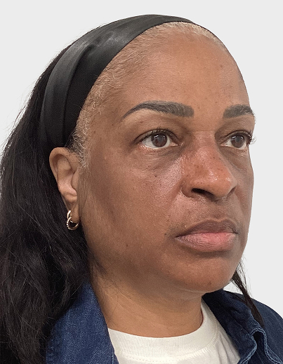 Cheek Temple Filler - Before