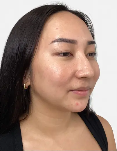 Chin Filler - After