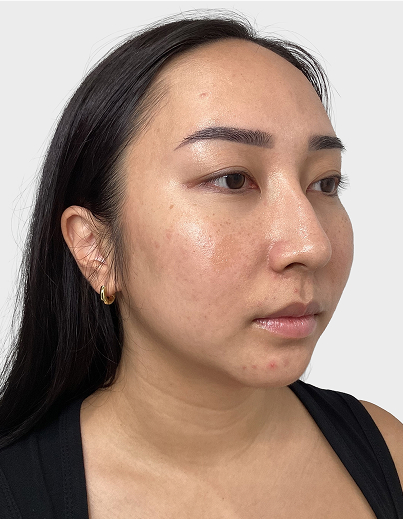 Chin Filler - Before