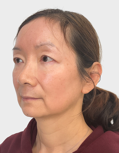 CO₂ Laser Treatment - After