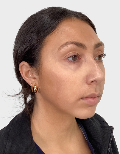 Jawline Filler - After