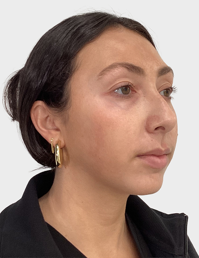 Jawline Filler - Before