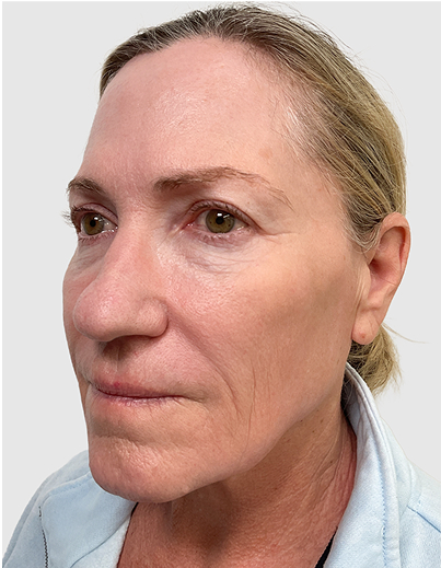 Jessner TCA Peel - After