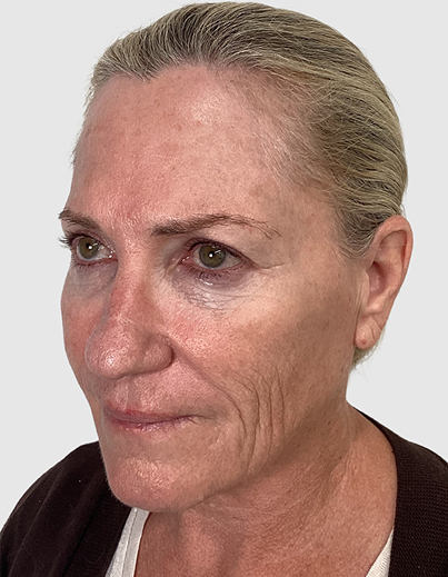 Jessner TCA Peel - Before