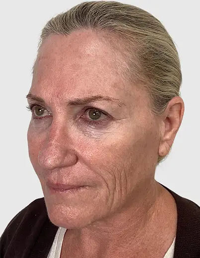 Jessner TCA Peel - Before