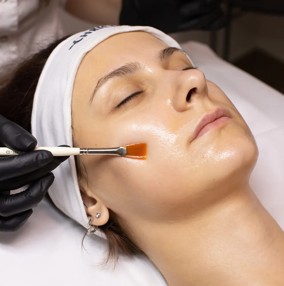 Jessner's Chemical Peel
