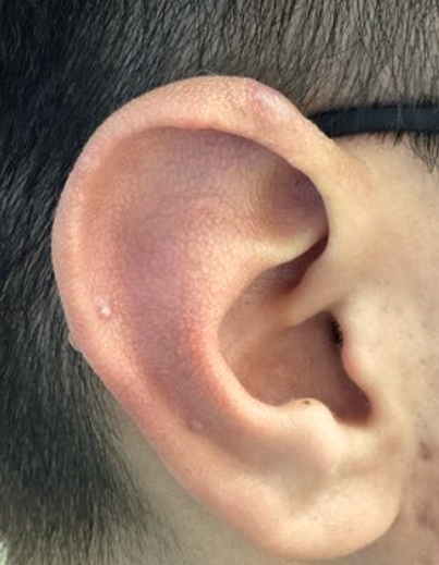 Keloid Removal - After