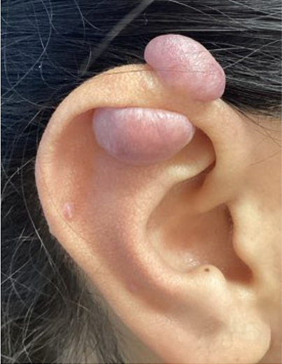 Keloid Removal - Before