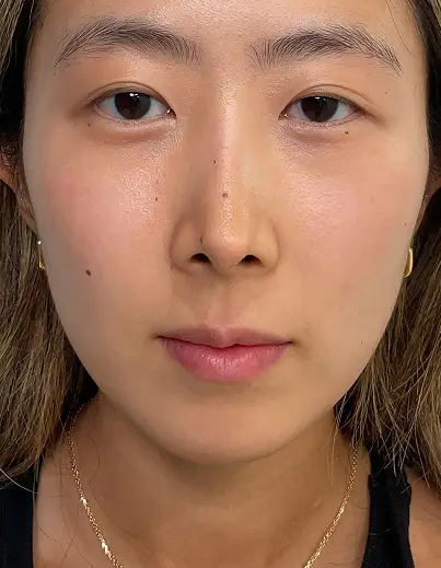 Lip Filler - After