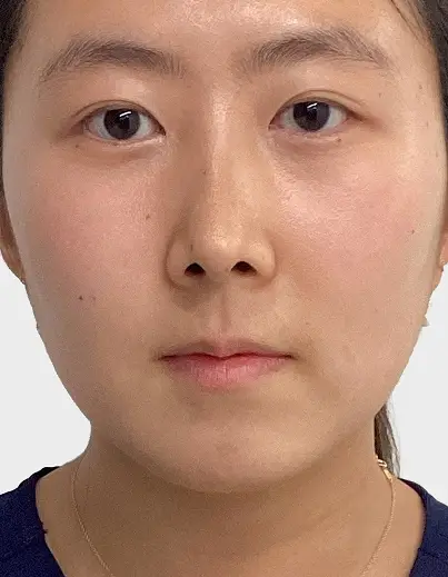 Lip Filler - Before